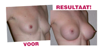 Afbeelding van de borsten van een vrouw met ervaring in het gebruik van Vacubreast